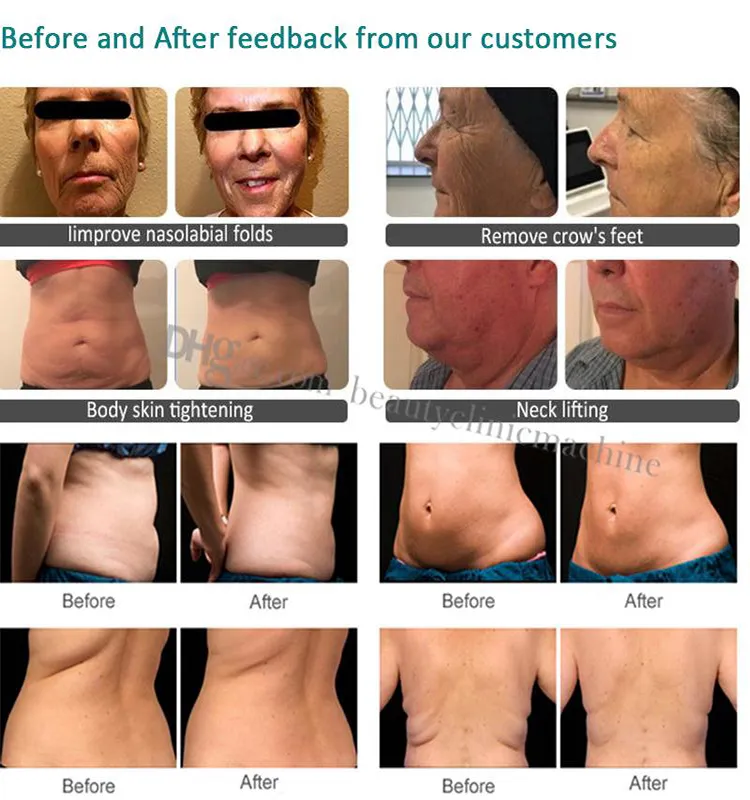 9d Hifu Face Lifting Anti Cellulite High-Intensity Focused Ultrasound Anti-Aging Wrinkle Removal Body Slimming Machine