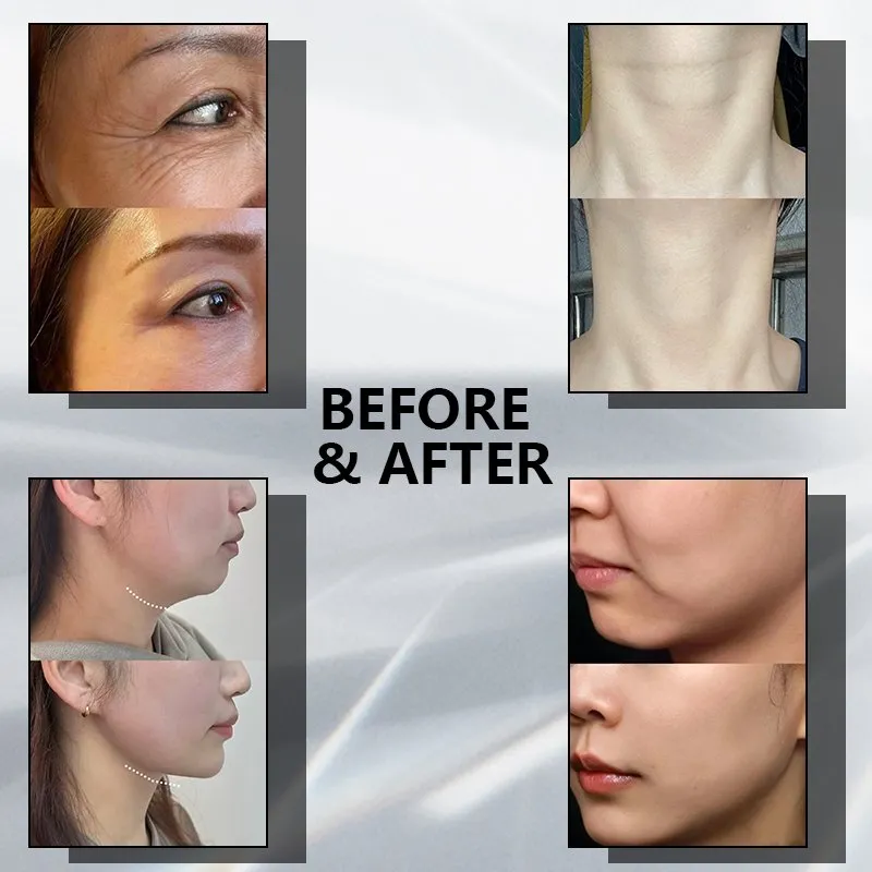 Focused Ultrasound Hifu Beauty Equipment Face Lifting Wrinkle Removal Skin Tightening Hifu Machine