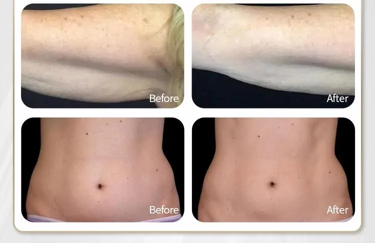 New 7D Hifu Arrival Beauty SPA Equipment Skin Tightening Wrinkle Removal V-Line Facial Lifting Anti Aging Himfu Mfu Machine